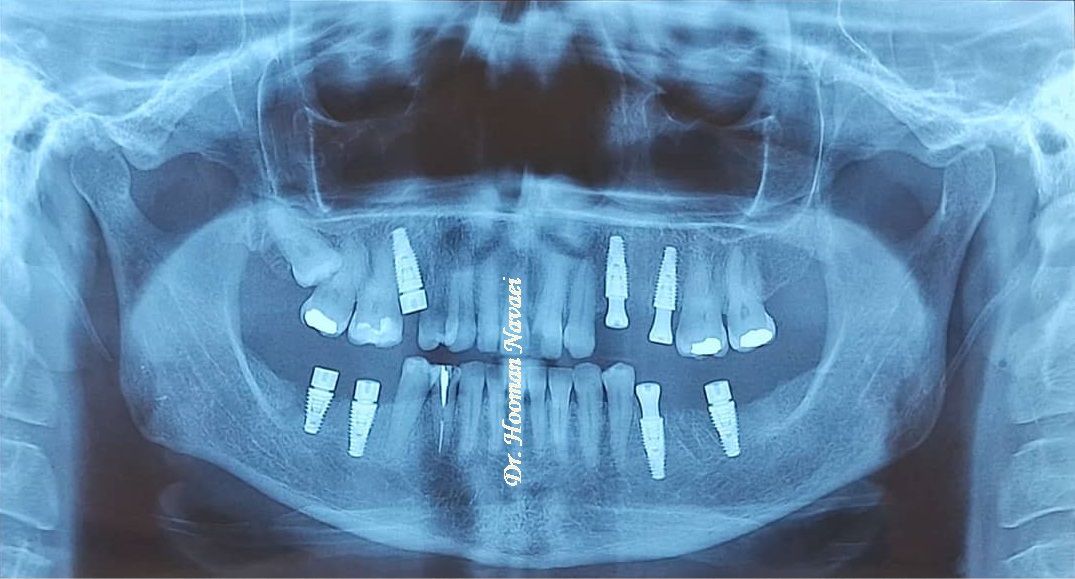کاشت ایمپلنت دندانی