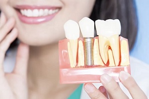 کاشت ضروری ایمپلنت