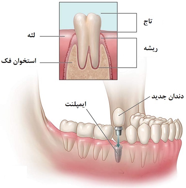 اجزاء ایمپلنت