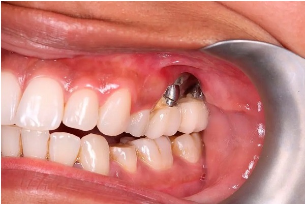 ایمپلنت دندان دکتر هومن نوایی