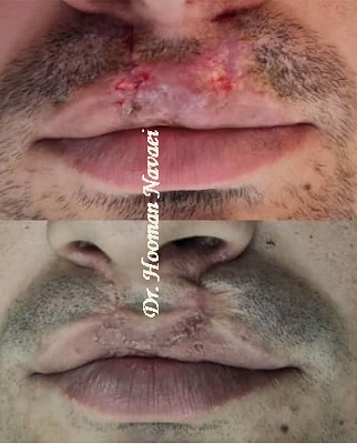 جراحی شکاف لب و کام دکتر هومن نوایی