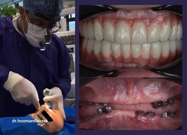 مراحل کاشت ایمپلنت