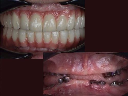 نمونه ایمپلنت دکتر نوایی