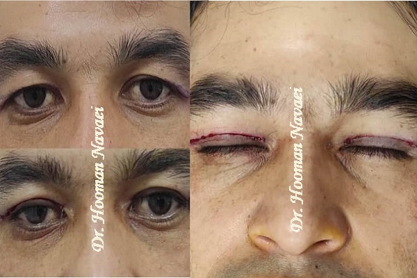 بلفاروپلاستی پلک شرقی