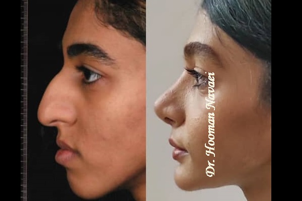 جراحی بینی دکتر نوایی