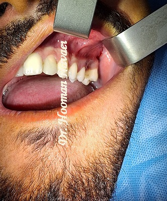 جراحی دندان عقل