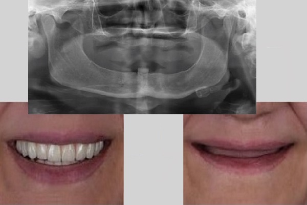 ایمپلنت فک بی دندان