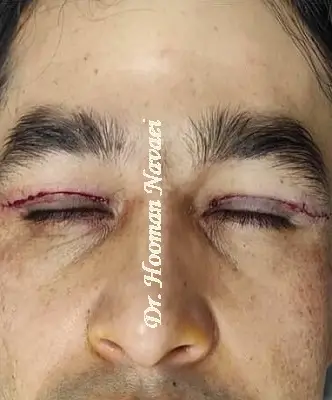 بلفاروپلاستی