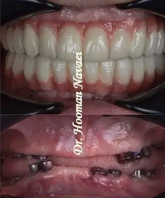 نمونه ایمپلنت