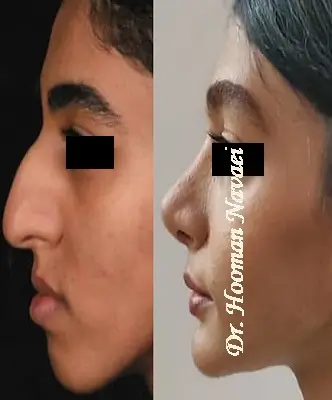 رینوپلاستی و جنیوپلاستی