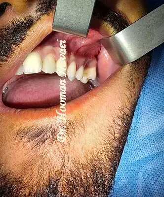 جراحی دندان عقل