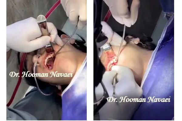 جراحی دندان نهفته توسط دکتر هومن نوایی
